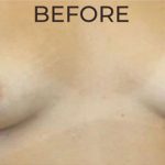 Breast Augmentation (Silicone) Before & After Patient #562