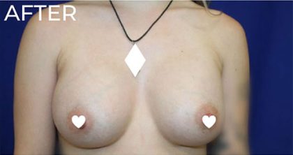 Breast Augmentation (Silicone) Before & After Patient #563