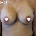 Breast Augmentation (Silicone) Before & After Patient #564