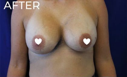 Breast Augmentation (Silicone) Before & After Patient #564