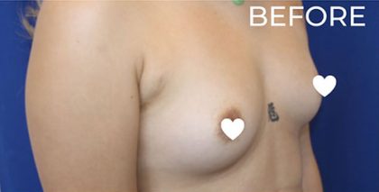 Breast Augmentation (Silicone) Before & After Patient #565
