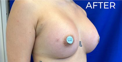 Breast Augmentation (Silicone) Before & After Patient #565