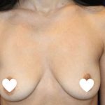 Breast Augmentation (Silicone) Before & After Patient #566