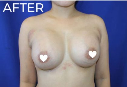 Breast Augmentation (Silicone) Before & After Patient #567