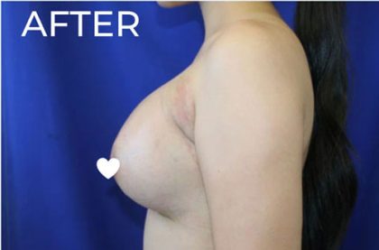 Breast Augmentation (Silicone) Before & After Patient #567
