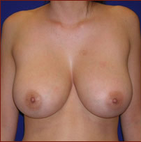 Breast Lift Before & After Patient #608