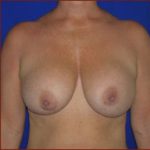 Breast Lift Before & After Patient #612