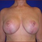 Breast Lift Before & After Patient #612