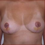 Breast Lift Before & After Patient #613