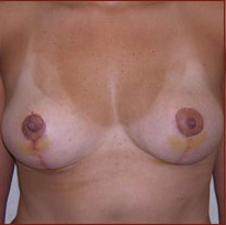 Breast Lift Before & After Patient #613