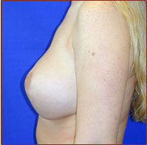 Breast Lift Before & After Patient #615