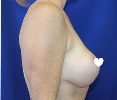 Breast Lift Before & After Patient #616