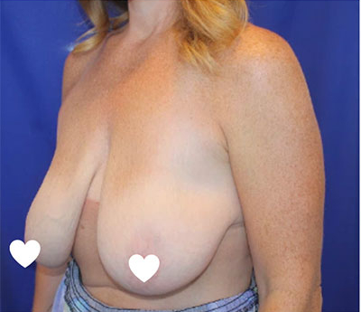 Breast Lift Before & After Patient #617