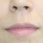 Dermal Fillers Before & After Patient #1194
