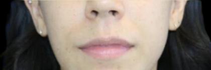Dermal Fillers Before & After Patient #1194