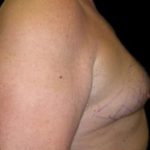Gynecomastia Before & After Patient #633