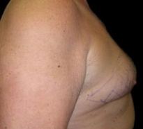 Gynecomastia Before & After Patient #633