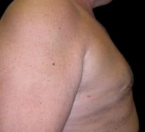 Gynecomastia Before & After Patient #633