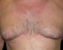 Gynecomastia Before & After Patient #635