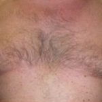 Gynecomastia Before & After Patient #635