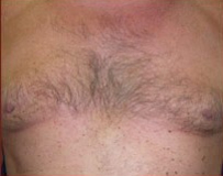Gynecomastia Before & After Patient #635
