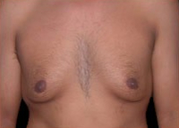 Gynecomastia Before & After Patient #636