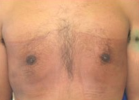 Gynecomastia Before & After Patient #636