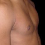 Gynecomastia Before & After Patient #638