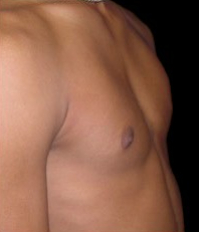 Gynecomastia Before & After Patient #638