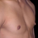 Gynecomastia Before & After Patient #638