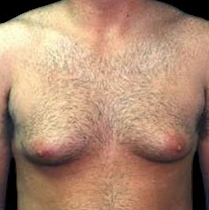 Gynecomastia Before & After Patient #644