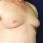 Gynecomastia Before & After Patient #646