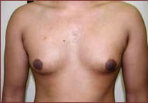 Gynecomastia Before & After Patient #647