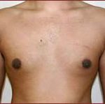 Gynecomastia Before & After Patient #647