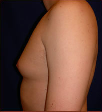 Gynecomastia Before & After Patient #631