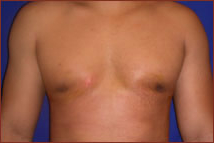 Gynecomastia Before & After Patient #632