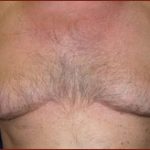 Gynecomastia Before & After Patient #635