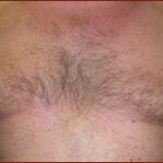Gynecomastia Before & After Patient #635