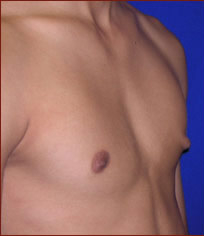 Gynecomastia Before & After Patient #638