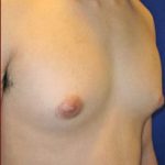 Gynecomastia Before & After Patient #639