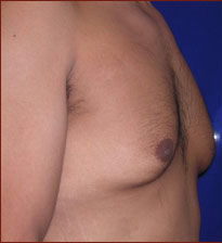 Gynecomastia Before & After Patient #642
