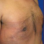 Gynecomastia Before & After Patient #642