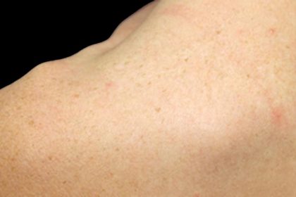 Laser Skin Resurfacing Before & After Patient #1219