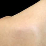 Laser Skin Resurfacing Before & After Patient #1219