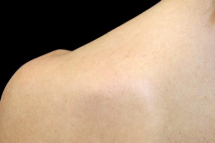 Laser Skin Resurfacing Before & After Patient #1219