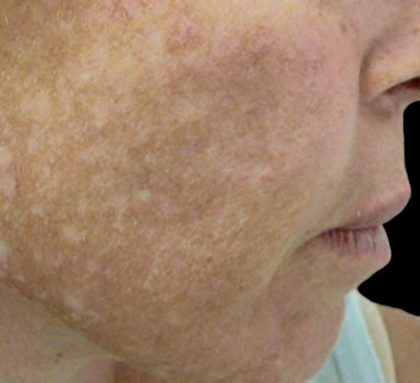 Laser Skin Resurfacing Before & After Patient #1225