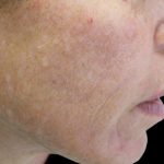 Laser Skin Resurfacing Before & After Patient #1225