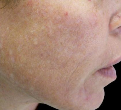 Laser Skin Resurfacing Before & After Patient #1225