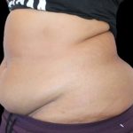 Tummy Tuck Before & After Patient #748