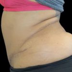 Tummy Tuck Before & After Patient #748